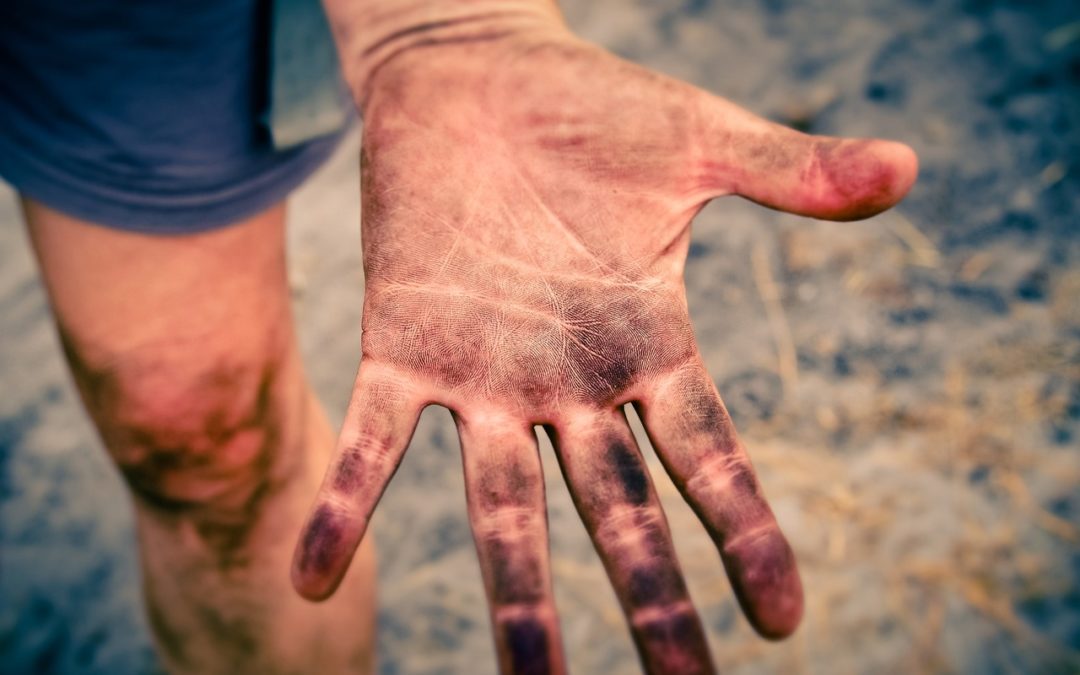 Comment traiter les cas de brûlure ?